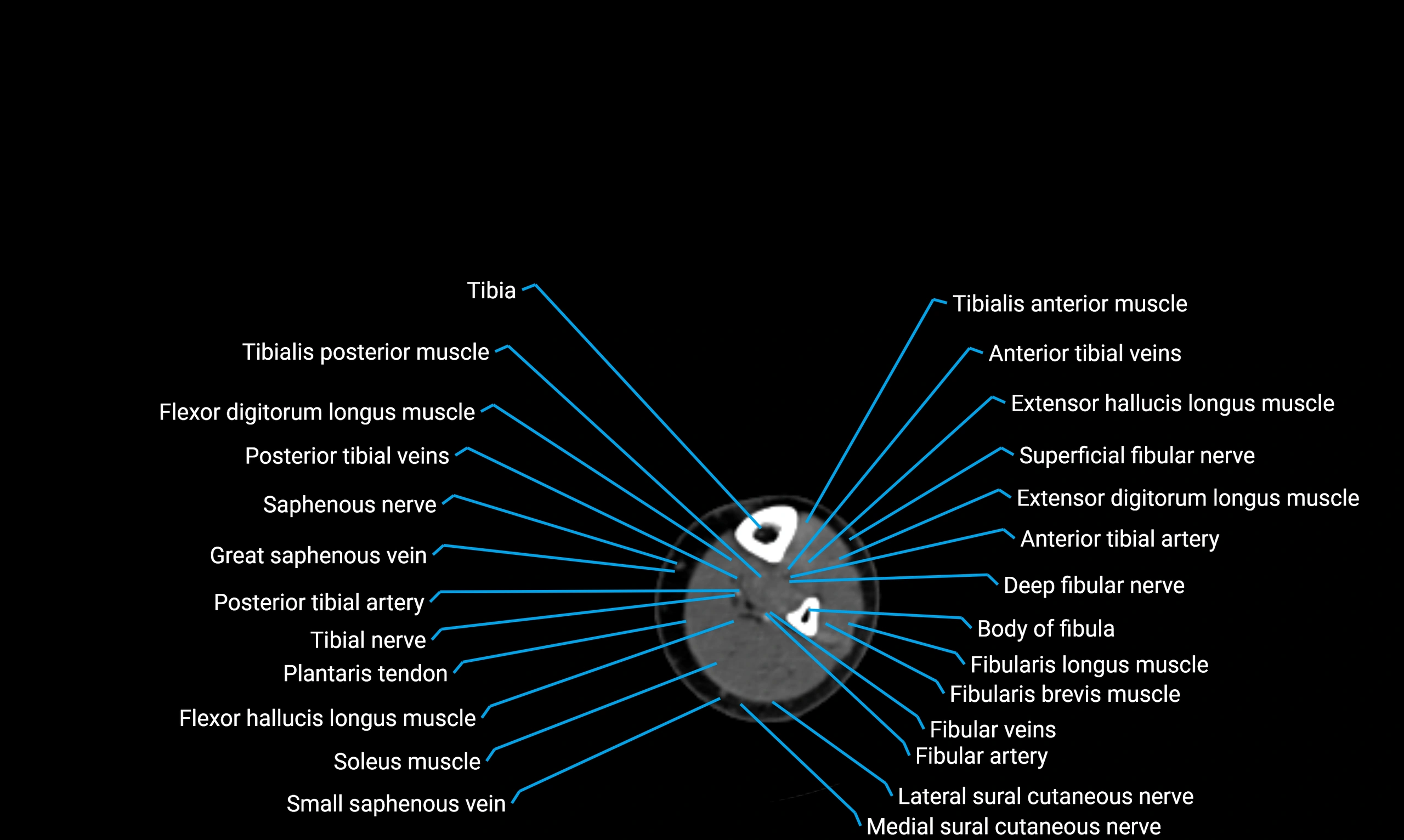CT lower limb axial cross sectional anatomy labelled image 133 (2).webp